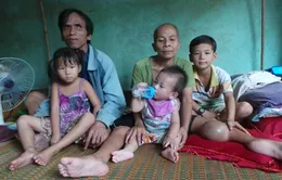 Người đàn bà mơ ước được... cắt bỏ chân