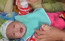 Tiếng khóc lặng của bé 5 tháng tuổi bị hở vòm và dị tật bộ phận sinh dục