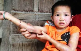 Bé 7 tuổi mất ăn, mất ngủ vì căn bệnh "lạ"