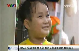 Cháu bé dân tộc Mông bị ung thư máu cần giúp đỡ!