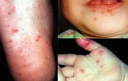 Dịch sốt xuất huyết, tay chân miệng có nguy cơ bùng phát  