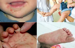 Nguy cơ bùng phát dịch bệnh tay chân miệng tại ĐBSCL