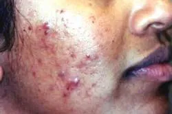 Cách điều trị mụn trứng cá 