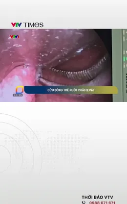 Cứu sống bé trai nuốt phải nhiều viên nam châm