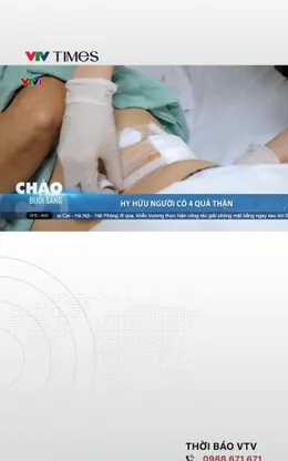 Người phụ nữ mang 4 quả thận suốt nhiều năm