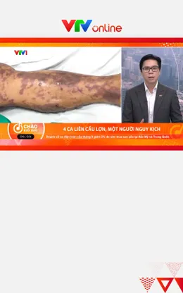 4 ca nhiễm liên cầu lợn trong 2 tuần, 1 người nguy kịch sau ăn tiết canh