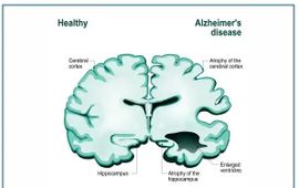 Xét nghiệm máu có thể phát hiện bệnh Alzheimer ở giai đoạn sớm