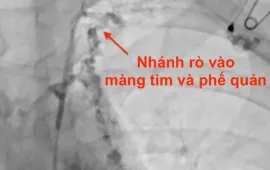 Đau ngực kèm theo khó thở, thanh niên phát hiện viêm phế quản "nhựa" hiếm gặp