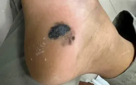 Tổn thương màu đen ở chân: Cẩn trọng nguy cơ ung thư tế bào hắc tố da