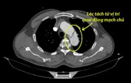 Kịp thời cứu người đàn ông bị lóc tách động mạch chủ ngực