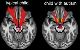 Phát hiện mới về hoạt động của não liên quan đến chứng tự kỷ