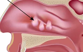 Phát hiện loại thuốc trị bệnh hô hấp quen thuộc cho kết quả tích cực đối với polyp mũi