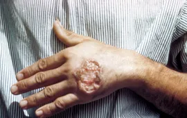 Thái Lan cảnh báo bệnh nhiễm ký sinh trùng Leishmania gây tử vong