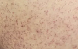 Cảnh báo dấu hiệu trở nặng ở trẻ mắc sốt xuất huyết