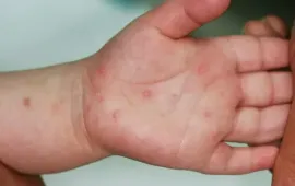 Hà Nội: Dịch sởi có xu hướng giảm, tay chân miệng tăng nhanh ở trẻ nhỏ