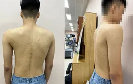 Khám miễn phí gù, vẹo cột sống cho trẻ dưới 18 tuổi