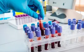 Hơn 40% người Việt có cholesterol máu cao