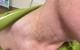 Phát hiện thêm ca bệnh giun rồng tại Phú Thọ