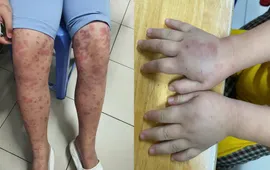 Cẩn trọng với ban xuất huyết Schonlein- Henoch ở trẻ