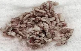 Giải thoát cơn ác mộng tiểu đêm, tiểu khó nhờ kỹ thuật xâm lấn tối thiểu