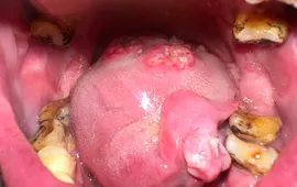 Ung thư khoang miệng: Các biểu hiện ban đầu thường gặp