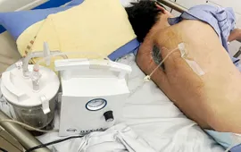 Thoát liệt nhờ phát hiện nhiễm nấm tại vết mổ cột sống ngực