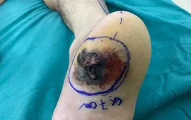 Vết loét gót chân 6 tháng không lành: Báo động ung thư da