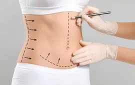 Hút mỡ siết eo 3 điểm - Bí quyết sở hữu vòng eo "con kiến"