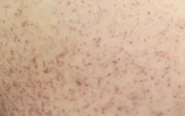 Cô gái 21 tuổi suýt mất mạng vì sốc sốt xuất huyết Dengue nặng