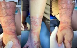 Cảnh báo mùa du lịch biển: Viêm da tiếp xúc do sứa biển