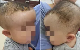 Bé 7 tháng tuổi bị tụ máu đầu do ngã giường