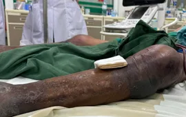 Nguy kịch vì viêm mô bào sau khi bị gai đâm vào chân ở đầm tôm