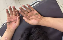 Cảnh báo tai nạn điện giật khi thả diều