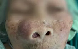Khối u làm lệch mặt cụ bà 94 tuổi, bác sĩ khéo léo bóc tách thành công
