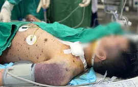 Biến chứng thủy đậu nguy kịch: Một ca xin về, một ca vẫn thở máy