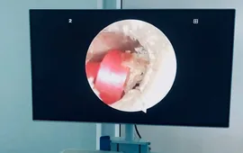Bé gái suýt thủng màng nhĩ vì sợi dây buộc tóc