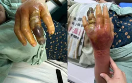 Nữ bệnh nhân hoại tử bàn tay vì vi khuẩn "ăn thịt người" từ gai cá ba gai