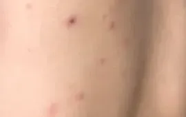 Cứu sống bé 10 tuổi bị thủy đậu biến chứng viêm não