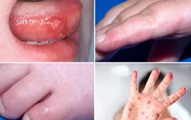 TP Hồ Chí Minh: Số ca mắc bệnh tay chân miệng tiếp tục tăng