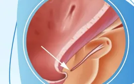 Lỗ tiểu thấp ở trẻ em: 5 dấu hiệu cha mẹ không nên bỏ qua