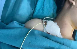 Viêm cơ tim cấp sau sinh: Sản phụ sống sót nhờ can thiệp kịp thời
