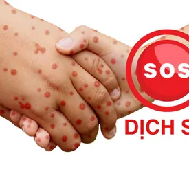 SOS - Dịch sởi