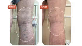 Foreign Tourist Recovers After Varicose Vein Treatment at Dr.Vein