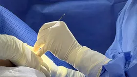 Causes of early breast implant rupture