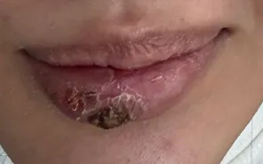 Cô gái trẻ suýt hoại tử môi sau tiêm tan filler tại spa không phép