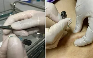 Phương pháp cấy chỉ catgut và ứng dụng điều trị bệnh