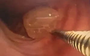 Nguy kịch vì nửa quả nho mắc kẹt ở phế quản