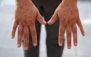 Anh ghi nhận ca đầu tiên nhiễm chủng mới của virus đậu mùa khỉ