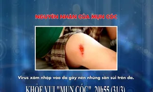 Khỏe Vui: Bệnh "mụn cóc" (20h55 thứ Bảy, 31/3)