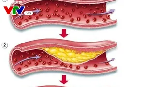 Chất lượng cuộc sống "Thiếu mãu não, nguy cơ đột quỵ" (16h15, Chủ Nhật, 05/8) trên VTV8